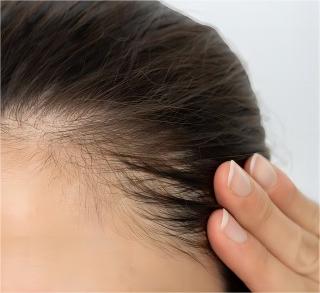 How To Hide Thinning Hair In The Front In Woman
