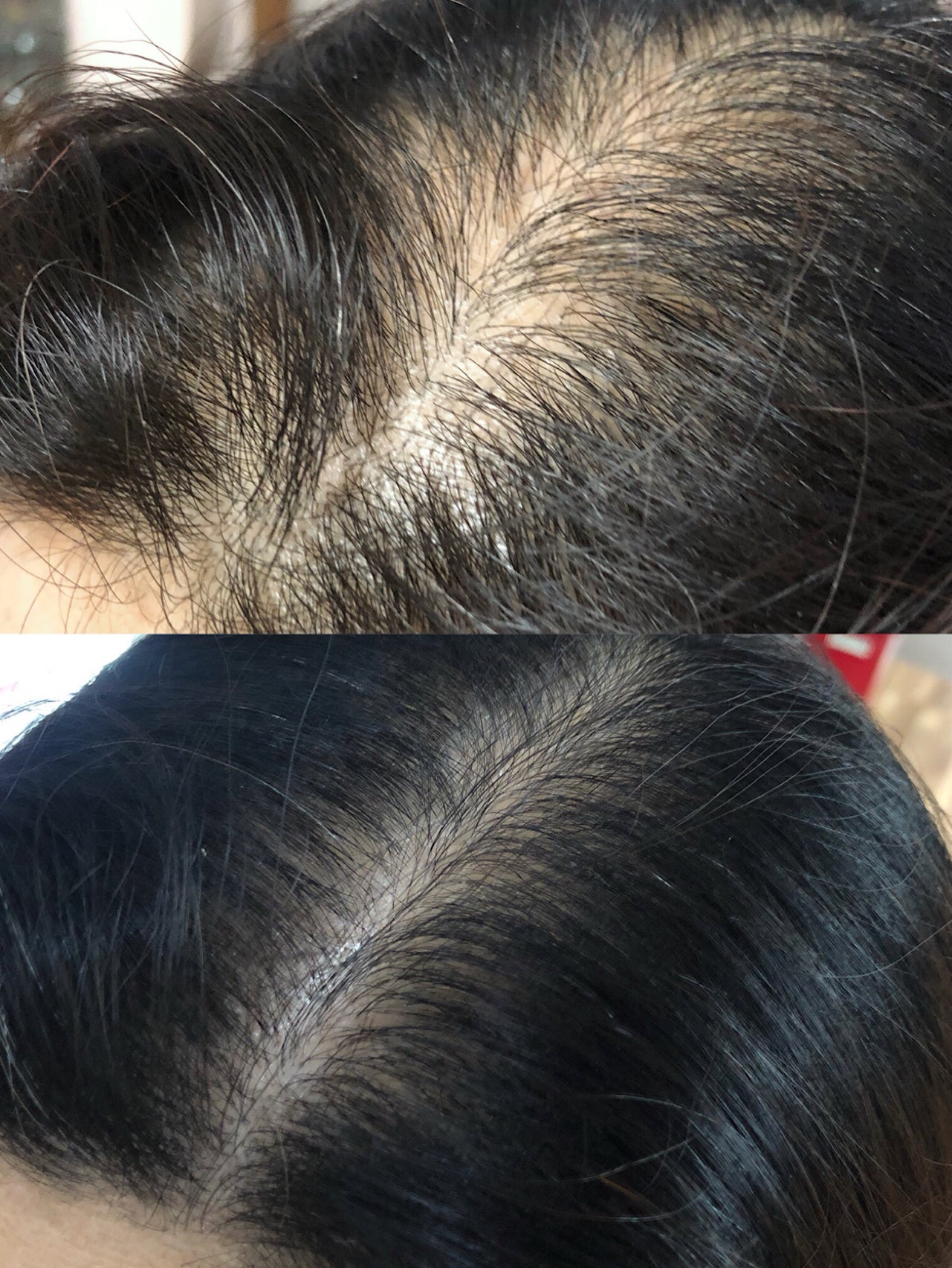 Normal Hair Part vs. Thinning Hair